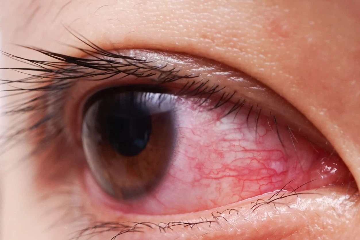 Mata Merah dan Nyeri? Waspadai 7 Gejala Umum Keratitis