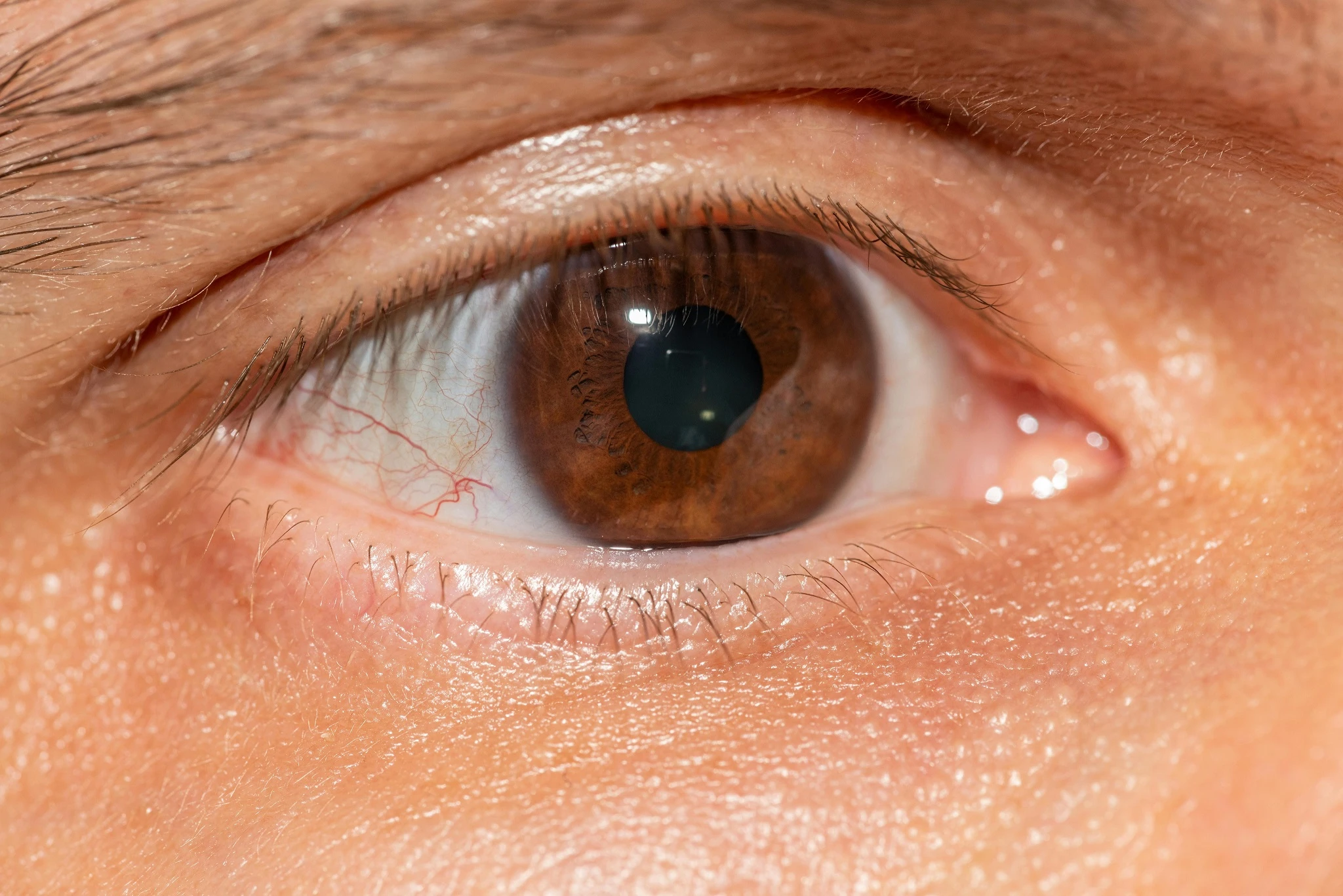 Kenali Keratitis: Peradangan Kornea yang Tak Boleh Dianggap Remeh